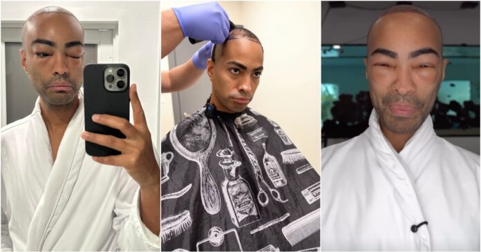 Pollito Tropical - implante capilar